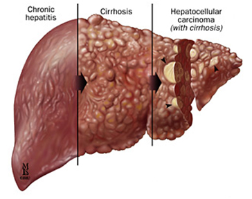 Liver Cirrhosis Ayurvedic Drops, Savliv Drops for Cirrhosis